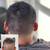 Male Pattern Baldness - Book Now 11 thumbnail