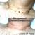 SKINTAG REMOVAL 7 thumbnail