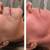 ProCell Microchanneling-Real Skin Rejuvenation 7 thumbnail