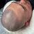 Male Pattern Baldness - Book Now 18 thumbnail