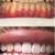 Teeth whitening, Toothgems, and grills 2 thumbnail