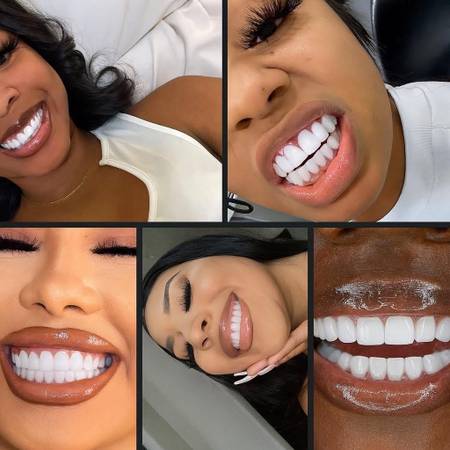 Do You Need Veneers?? Insurance doesn't cover cosmetic? I can help! 1