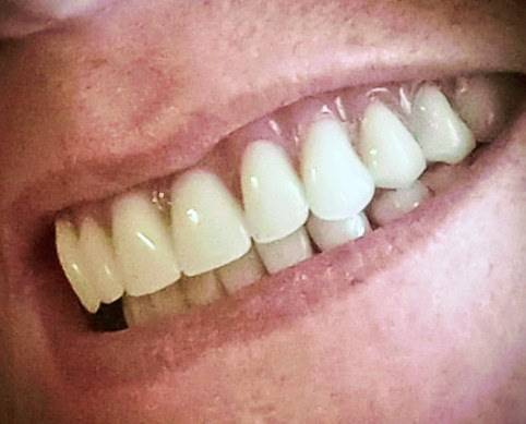 Dentures & Partials Repairs - Same Day Service 1