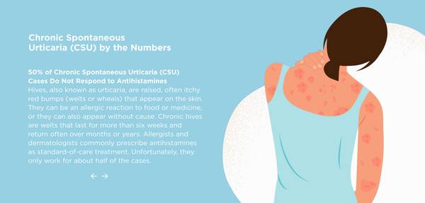 Join An Urticaria (Hives) Research Study 1