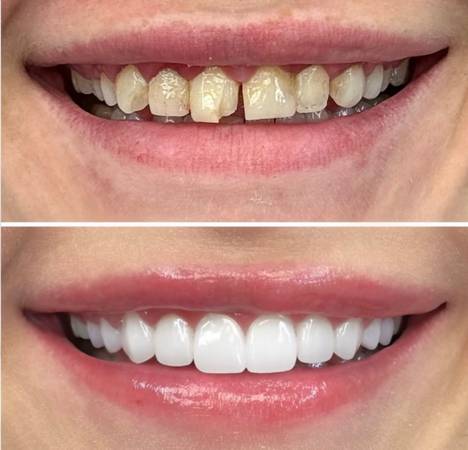 Crowns & Veneers - $500 1