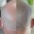 Male Pattern Baldness - Book Now 12 thumbnail