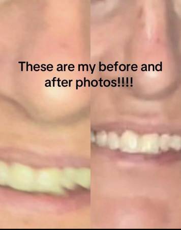 Professional, laser, teeth, whitening service 1