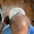 MODELS NEEDED! Scalp Micropigmentation (SMP) - Hair Loss 3 thumbnail