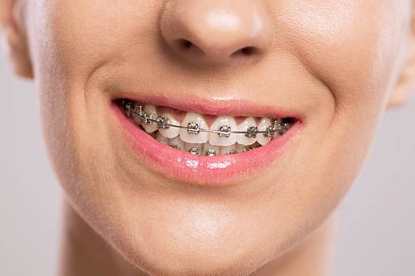 Top Things to Know Before Getting Braces 1