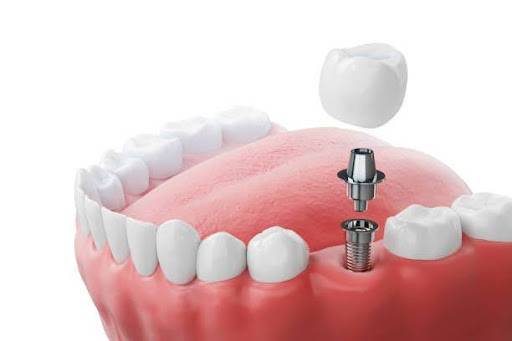 Are Dental Implants Worth the Investment? 1