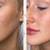 2-DAY BOTOX CERTIFICATION COURSE: BASIC & ADVANCED 9 thumbnail
