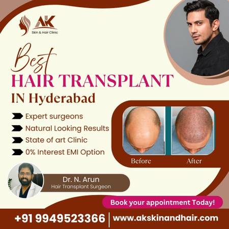 Best Hair Transplant Surgeon – Restore Your Confidence Today! 1