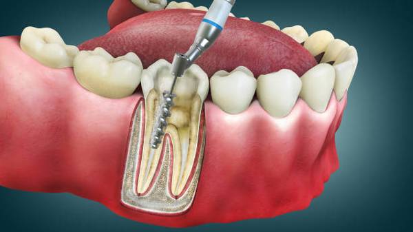 Why You Should Choose a Specialist for Your Root Canal 1
