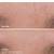 NEW BEAUTYBIO GloPro At-Home Microneedling Pen Tool 7 thumbnail