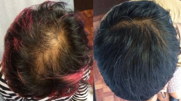 Stimulate Hair Regrowth with STM Treatment at H-Cura Clinic 1