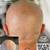 Male Pattern Baldness - Book Now 8 thumbnail