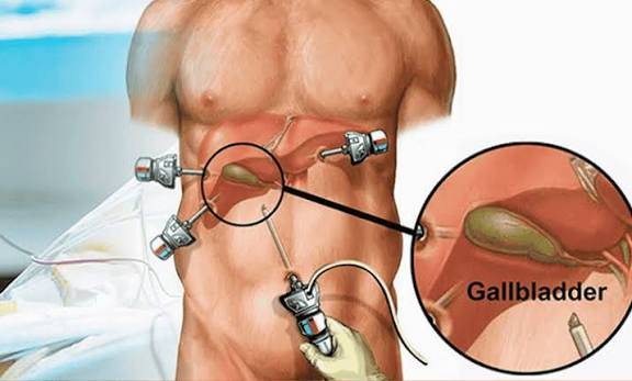 Affordable Gallbladder Stone Surgery Packages in Kolkata 1