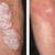 Haloderm Cream For Eczema and Psoriasis 1 thumbnail